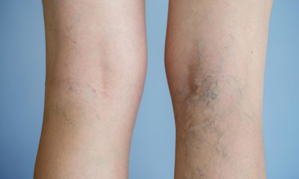 Symptoms of Varicose Veins – Explody Full